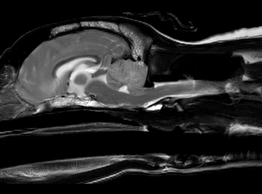 小脳ヘルニアのMRI画像